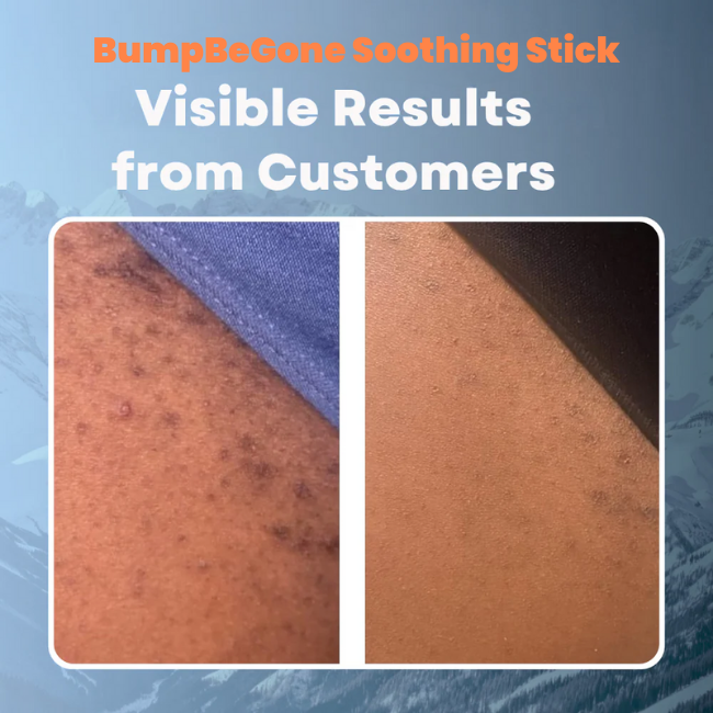 Tuarte™ BumpBeGone Soothing Stick